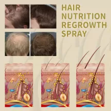 OUHOE Hair Regrowth Spray