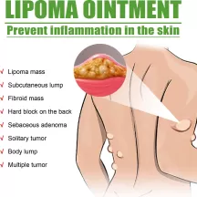 OUHOE Lipoma Removal Cream