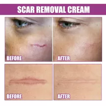 ouhoe scar removal cream