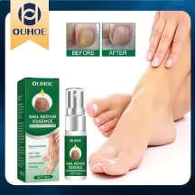 OUHOE Nail Fungal Treatment Serum